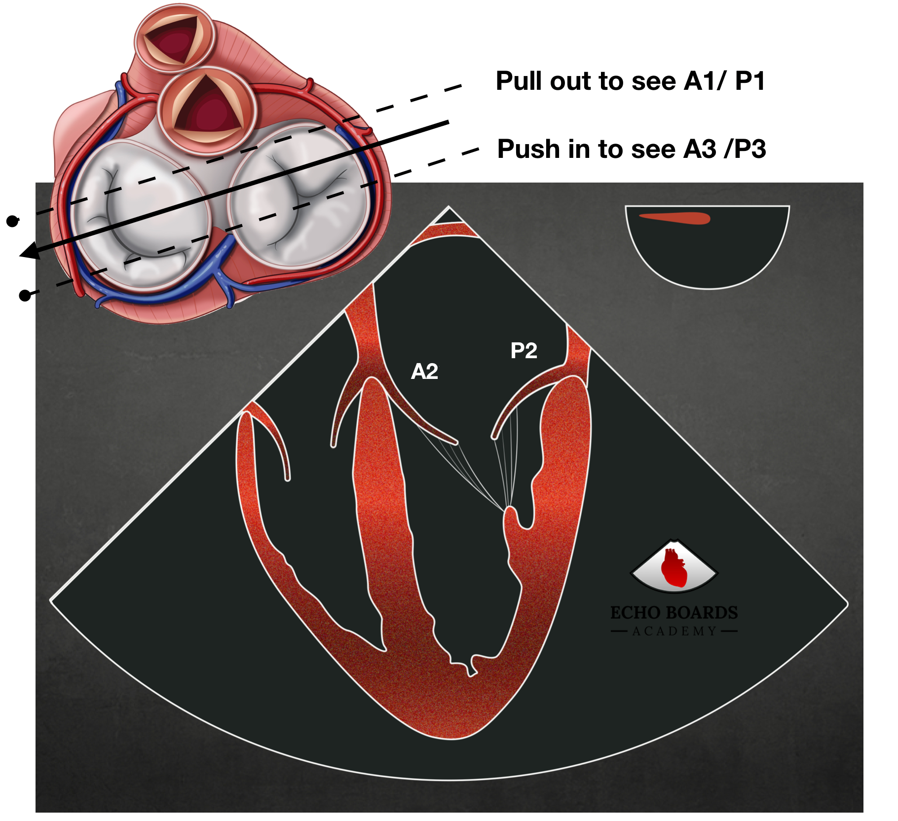 Mitral Valve Anatomy | EchoBoardsAcademy